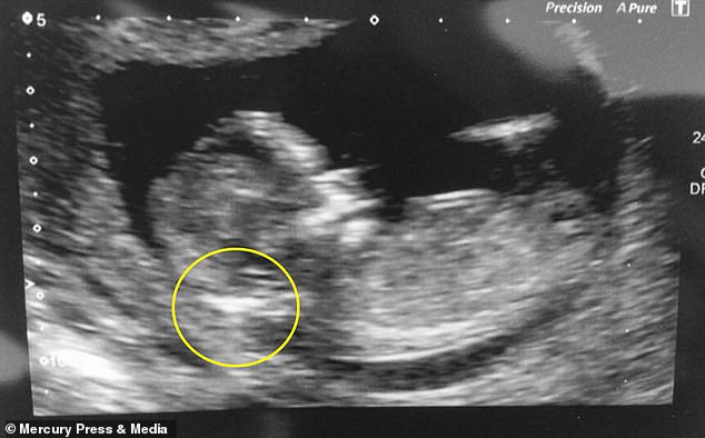 Jordan Squires 12 week pregnancy scan showing fluid on the back of baby Jays neck which worried doctors, making them fear the child would be born with Down SyndromeÂ