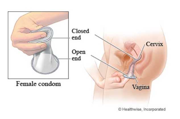 Γυναικεία προφυλακτικά: Πως είναι; Τι πρέπει να γνωρίζεις