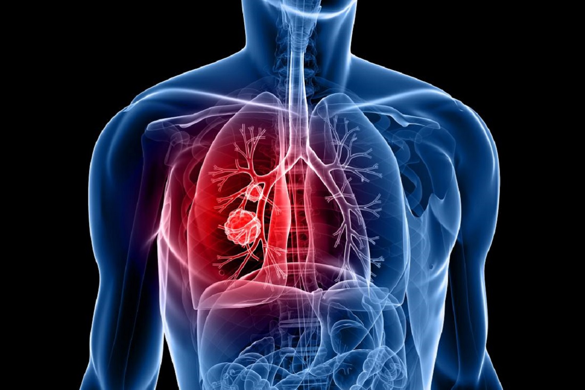 Kαρκίνος του πνεύμονα: Γίνεται να μην προκαλεί βήχα;