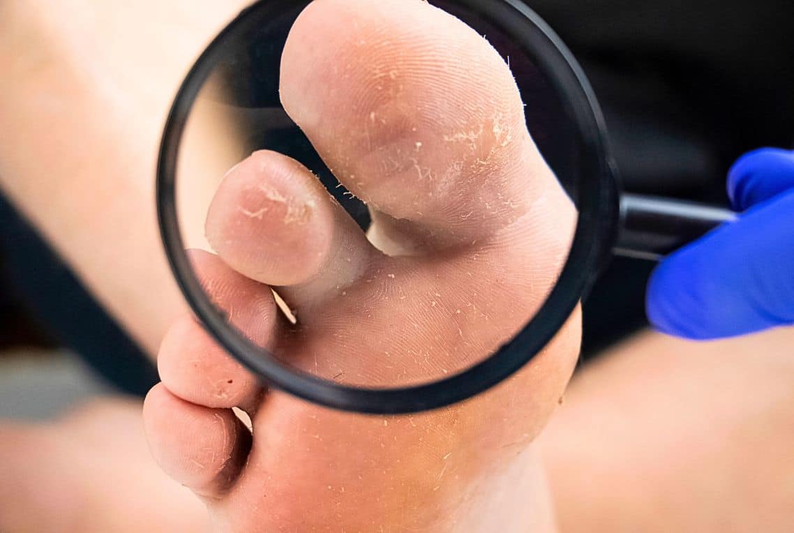 Μύκητες των ποδιών: Με αυτόν τον τρόπο θα απαλλαγείς μια και καλή