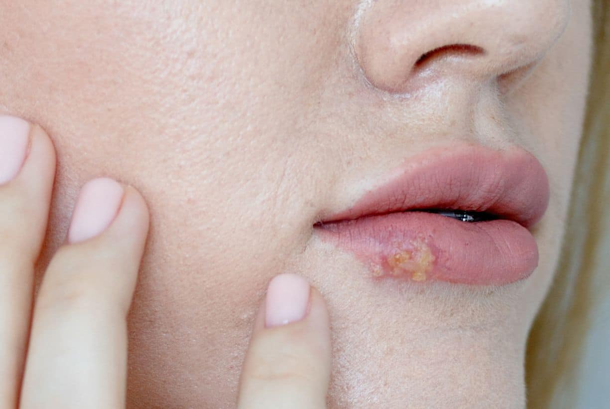 Έρπης στα χείλη: Αυξάνει τον κίνδυνο για άνοια