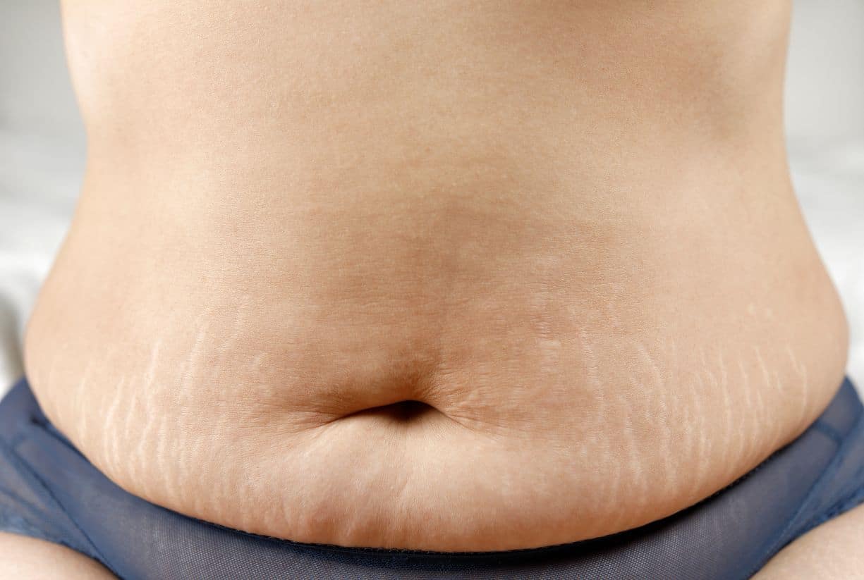 7 φυσικοί τρόποι να απαλλαγείς από τις ραγάδες